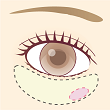 下眼瞼切開術/下眼瞼除皺術/ハムラ法