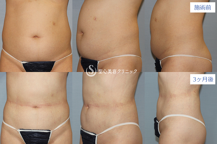 症例写真 術前術後比較 ベイザーリポ2.2脂肪吸引 腹部
