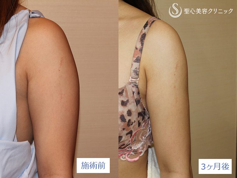 症例写真 術前術後比較 ベイザーリポ2.2脂肪吸引　二の腕