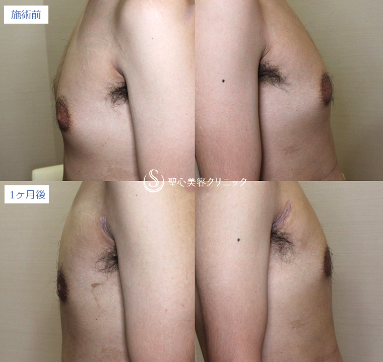 症例写真 術前術後比較 ベイザーリポ2.2脂肪吸引 胸