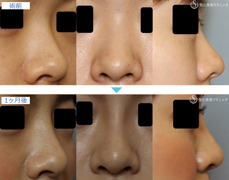 症例写真 術前後比較 鼻の整形