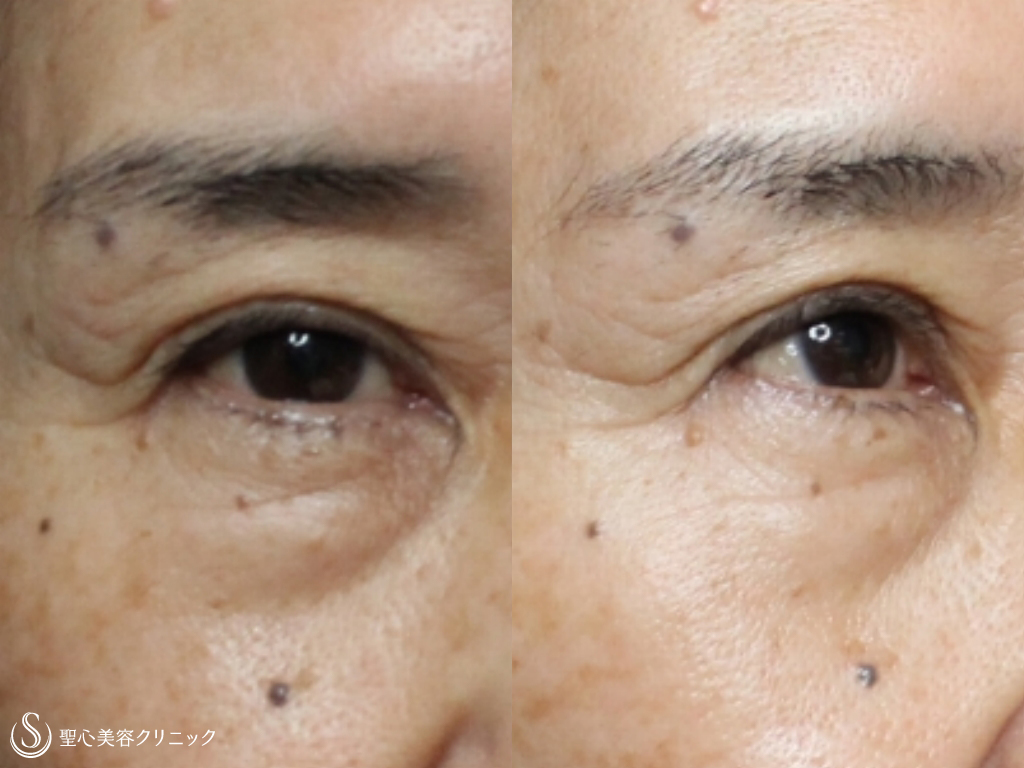 症例写真 術前 眉下切開法+プレミアムPRP皮膚再生療法