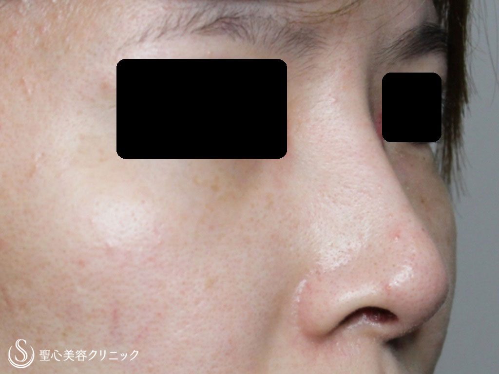 症例写真 術後 鼻のプロテーゼ、耳介軟骨移植