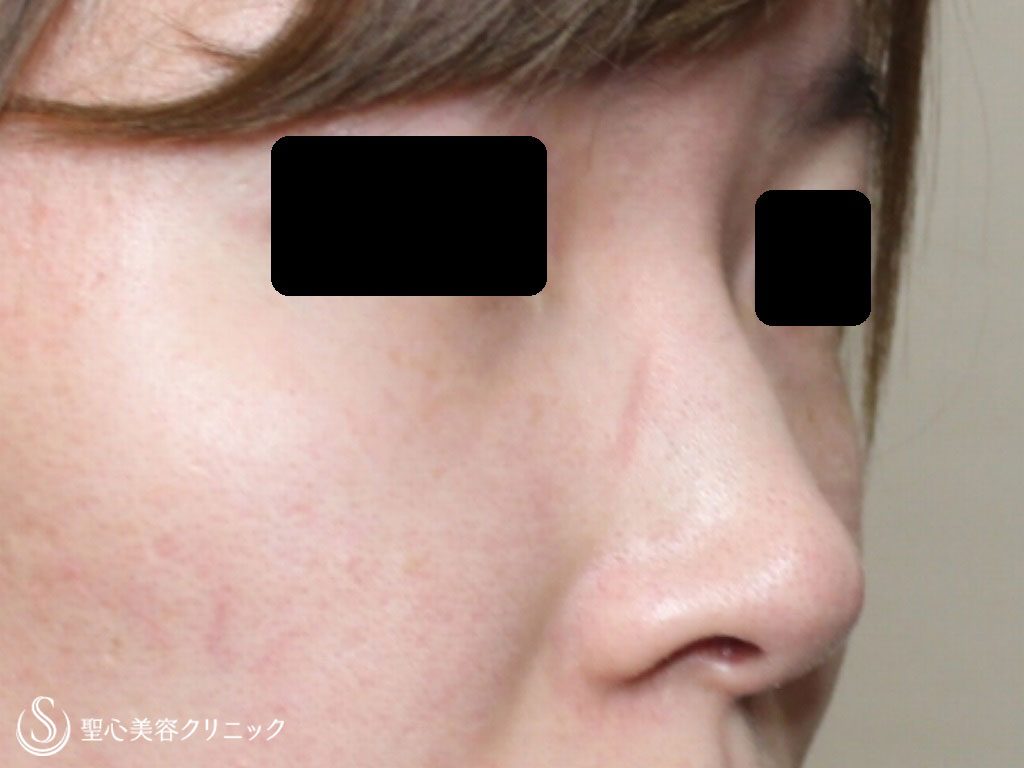 症例写真 術前 鼻のプロテーゼ、耳介軟骨移植