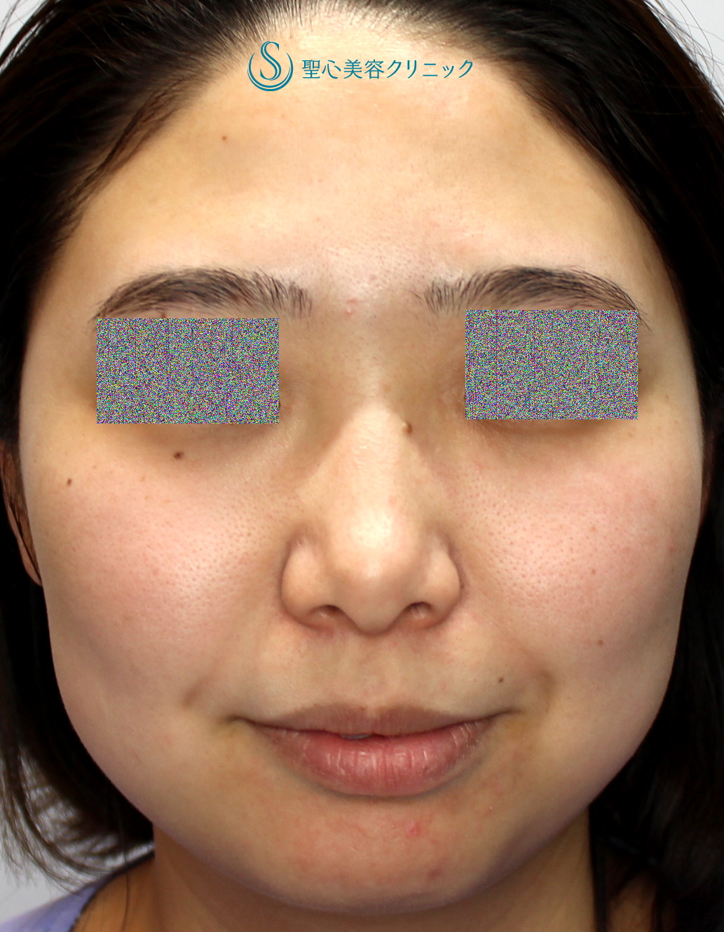 症例写真 術前 プロテーゼによる隆鼻術