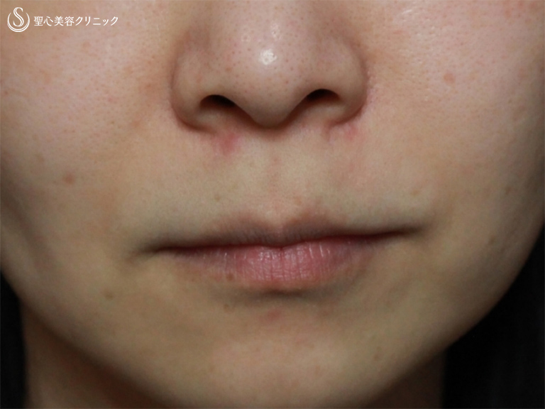 症例写真 術前 小鼻縮小+リップリフト+プレミアムスマイル切開術