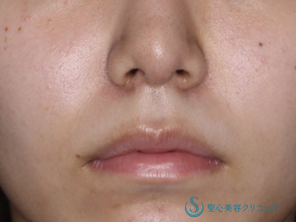 鼻の整形 鼻筋 鼻先 の症例写真 聖心美容クリニック大阪院