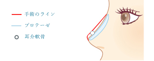 鼻プロテーゼ × 鼻尖形成（耳介軟骨移植）