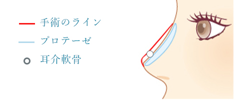 鼻プロテーゼ × 鼻尖形成（耳介軟骨移植）