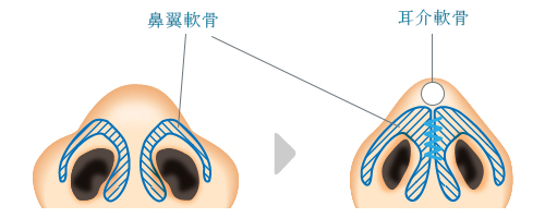 鼻尖縮小 × 鼻尖形成（耳介軟骨移植）