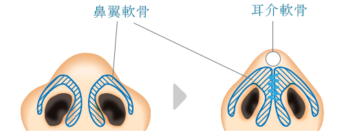 鼻尖縮小 × 鼻尖形成（耳介軟骨移植）