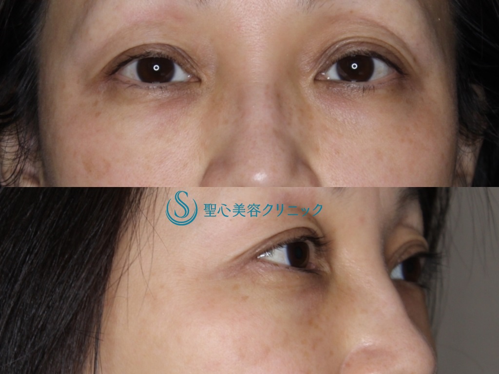 目の下の脂肪取り（経結膜下脱脂法）+プレミアムPRP皮膚再生療法（目の下のくま）_After