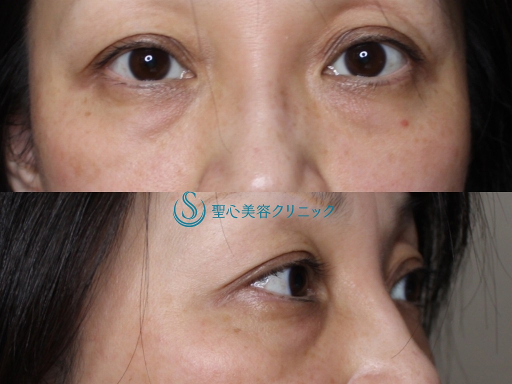 目の下の脂肪取り（経結膜下脱脂法）+プレミアムPRP皮膚再生療法（目の下のくま）_Before