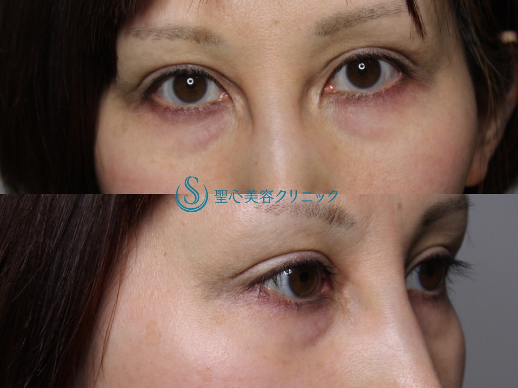 眉下切開法（眉下リフト）+目上切開+プレミアムPRP皮膚再生療法_Before