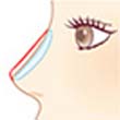 3Dオーダーメイドプロテーゼ隆鼻術