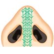 ベストリノプラスティー（鼻中隔・鼻尖形成）