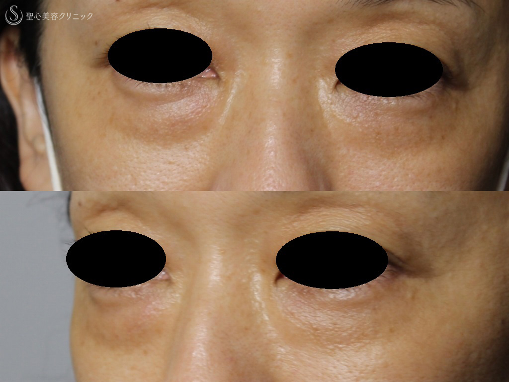 目の下の脂肪取り（経結膜下脱脂法）＋プレミアムPRP皮膚再生療法（目の下のくま）_Before