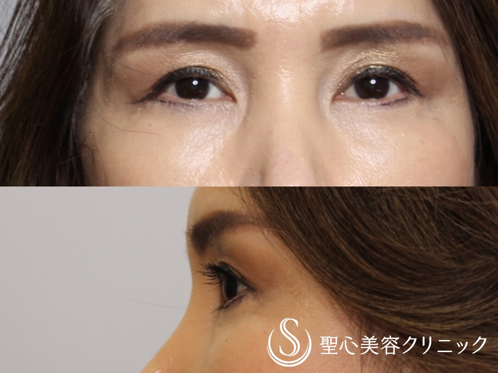 プレミアムPRP皮膚再生療法（目元のくぼみ・たるみ）＋眉下切開法（眉下リフト）_After