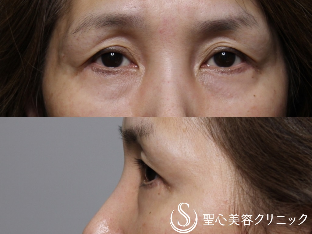 プレミアムPRP皮膚再生療法（目元のくぼみ・たるみ）＋眉下切開法（眉下リフト）_Before