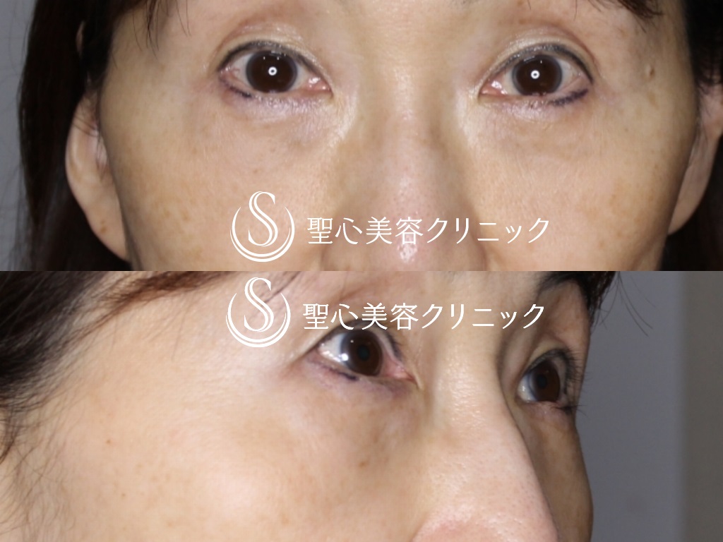プレミアムPRP皮膚再生療法+目の下の脂肪取り（経結膜下脱脂法）