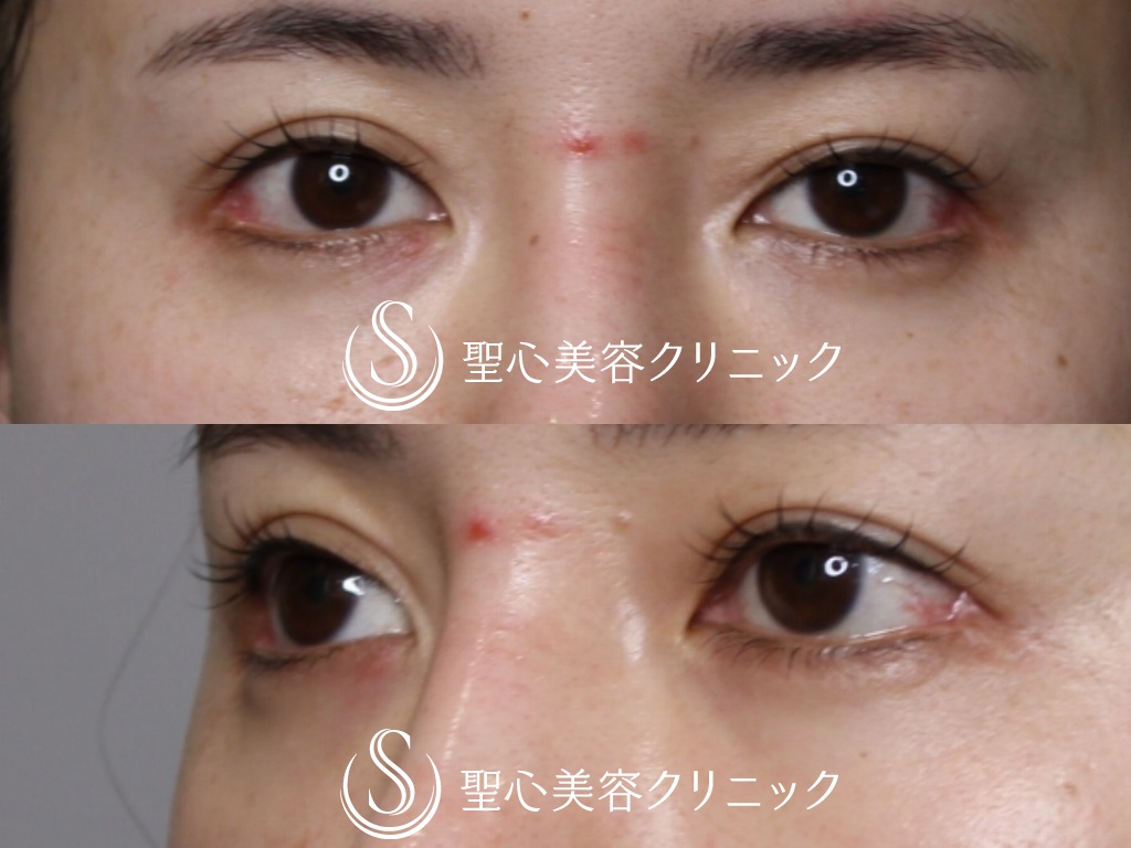 プレミアムPRP皮膚再生療法（目元のくぼみ・たるみ）+たれ目形成 埋没法（グラマラスライン/下眼瞼下制術）+目尻切開_After