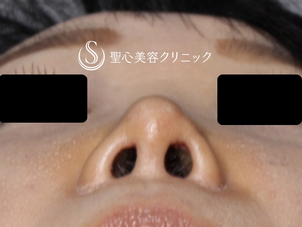 鼻尖形成（耳介軟骨移植）+鼻尖縮小+鼻孔縁下降術_After