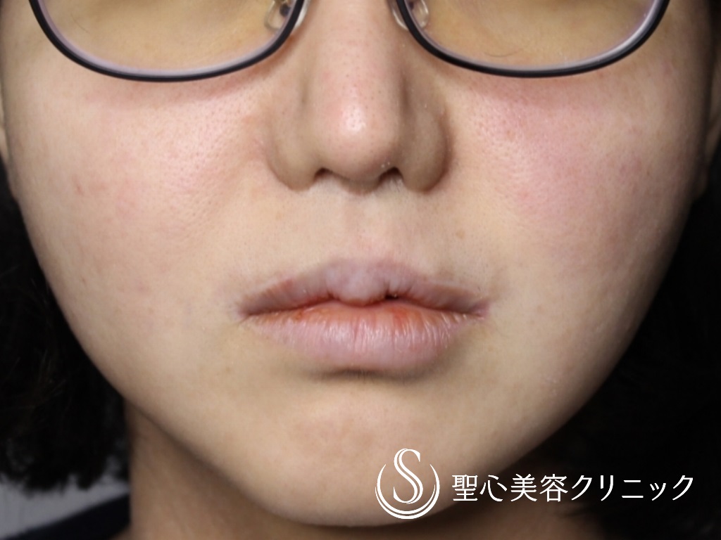 鼻下短縮術（リップリフト/人中短縮）_Before