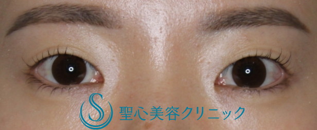 二重術（埋没法）：マイクロメソッド+α_Before