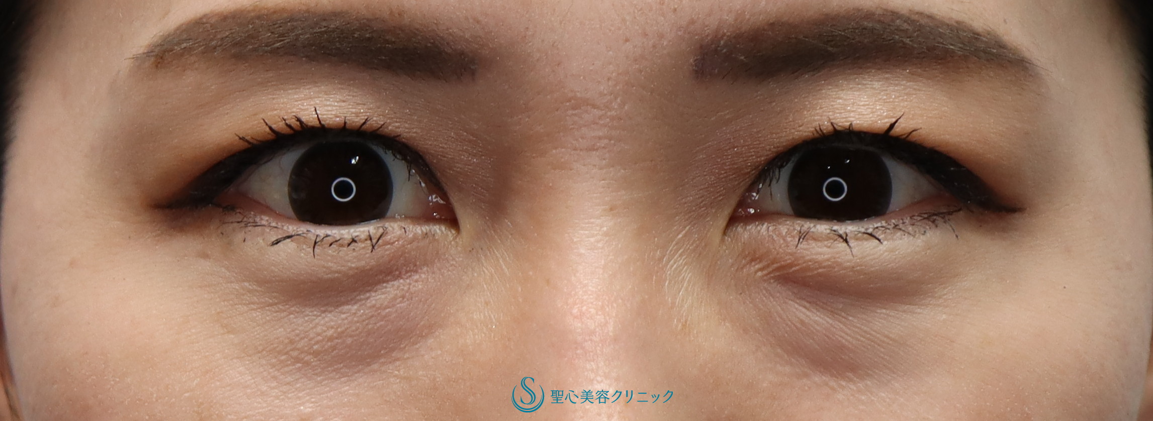 症例写真 術前 目の下の脂肪取り（経結膜下脱脂法）
