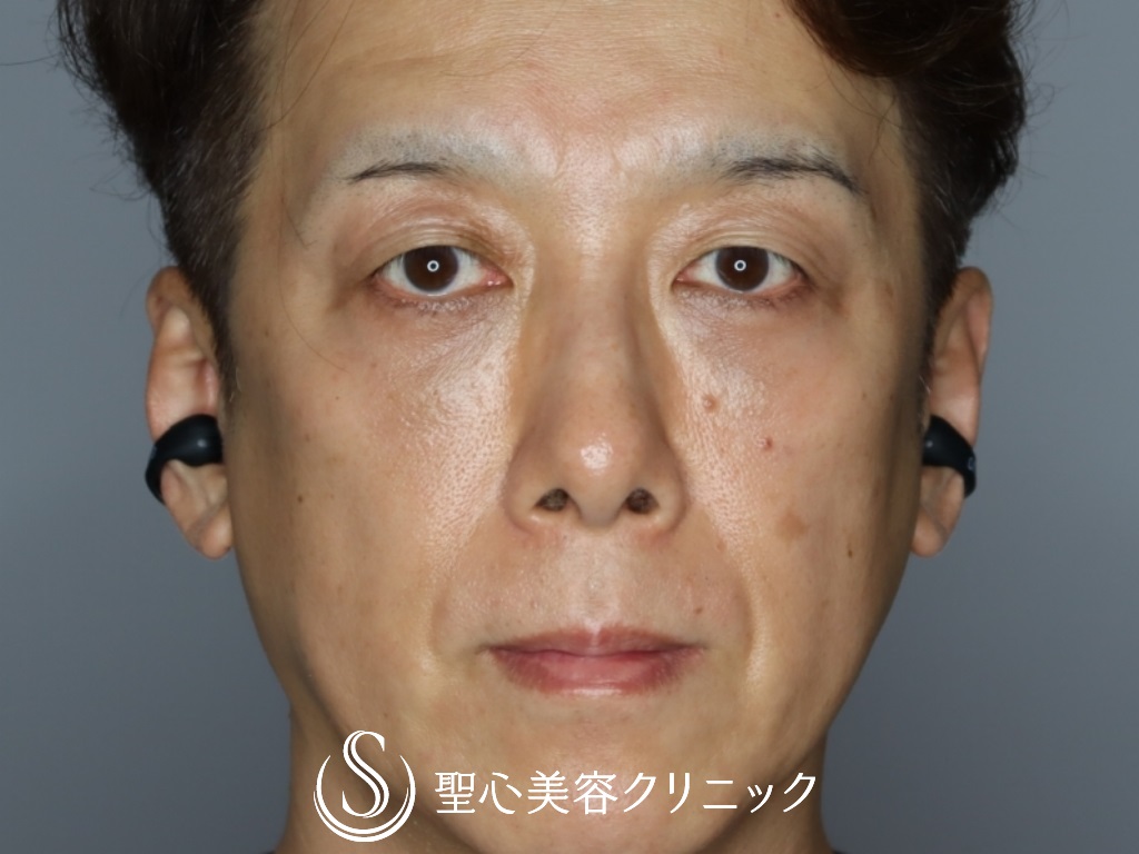 プレミアムPRP皮膚再生療法+目の下の脂肪取り（経結膜下脱脂法）_After