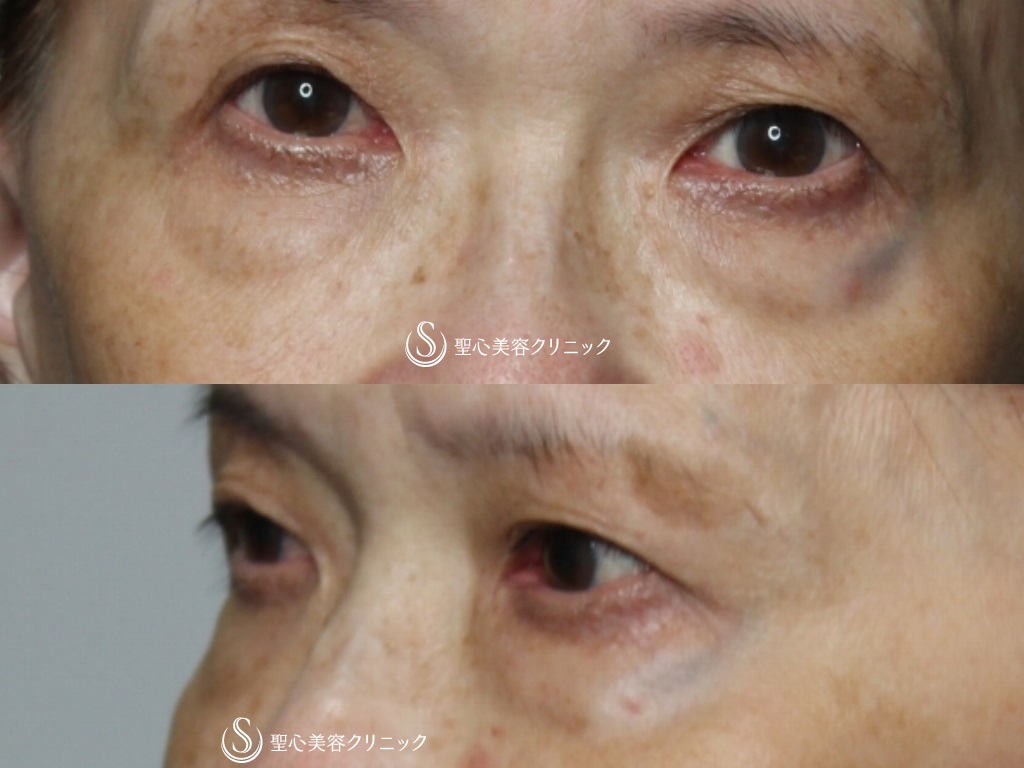 プレミアムPRP皮膚再生療法+目の下の脂肪取り（経結膜下脱脂法）_Before