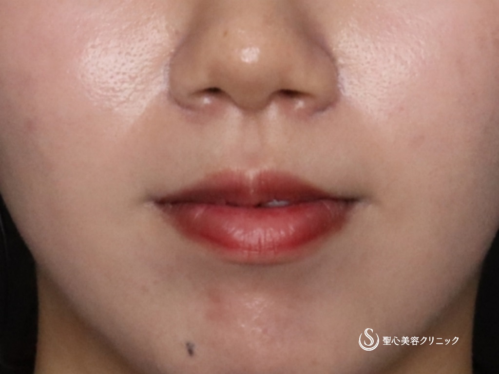 人中短縮ボトックス注入_Before
