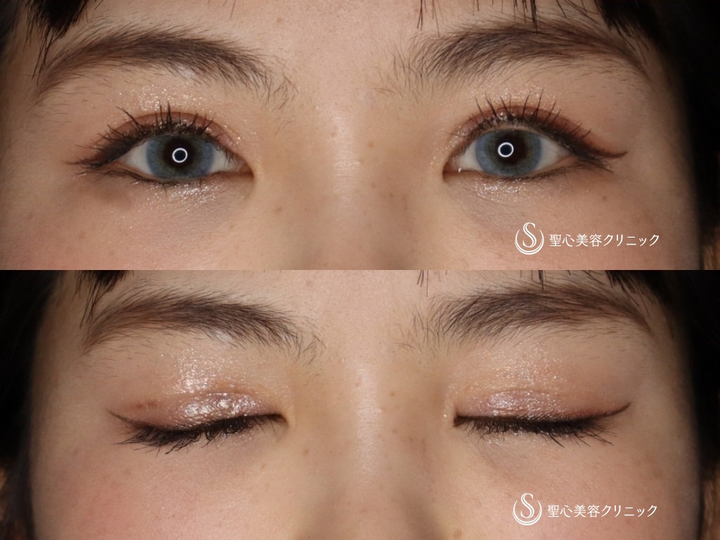 睫毛上皮膚切除_After