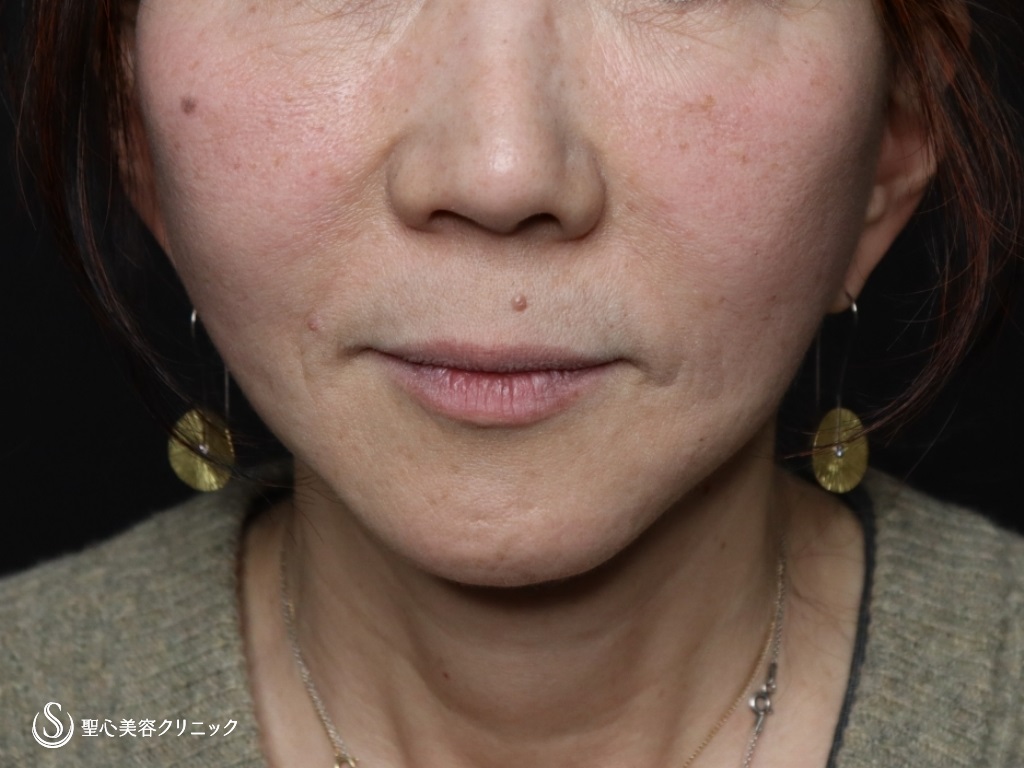 広範囲の切開リフト（プレミアムミニリフト＋ネックリフト）＋リガメント処置＋頬アゴ下脂肪吸引注射_After