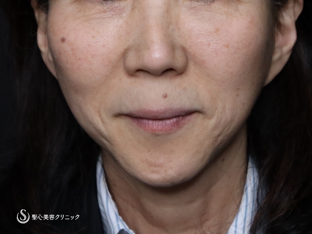 広範囲の切開リフト（プレミアムミニリフト＋ネックリフト）＋リガメント処置＋頬アゴ下脂肪吸引注射_Before