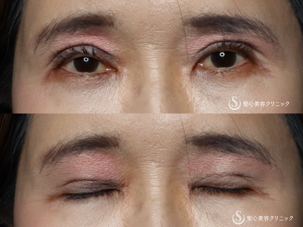 重瞼線部分開法_After