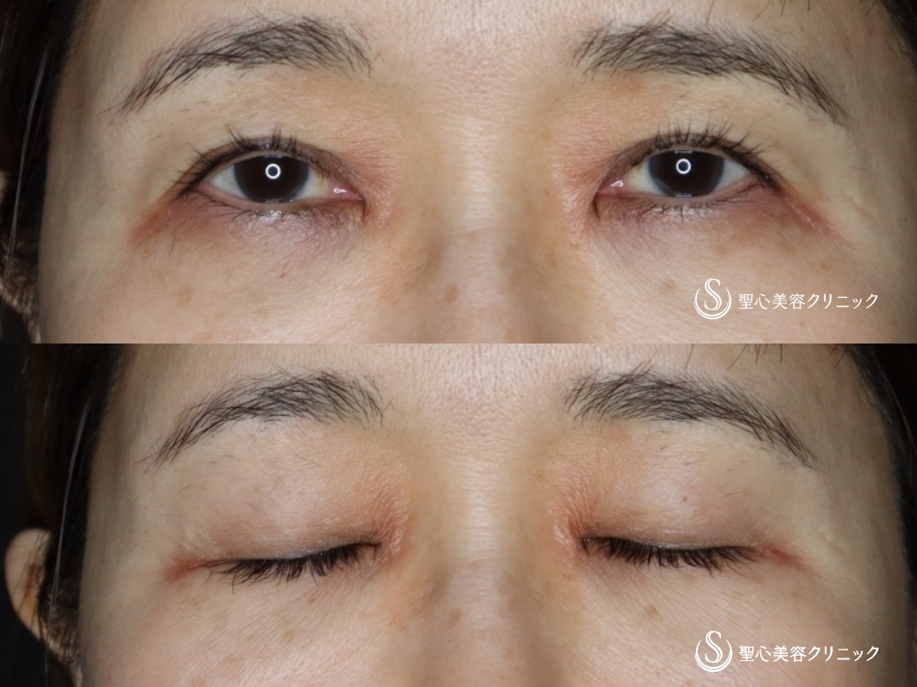 重瞼線部分開法_Before