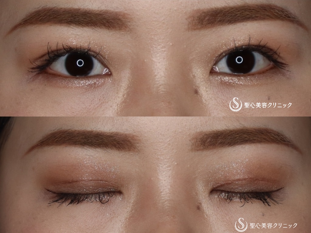 二重術（切開法）部分切開／全切開＋眼窩脱脂_After