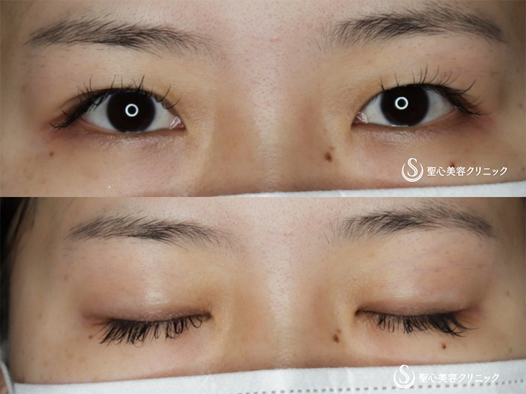 二重術（切開法）部分切開／全切開＋眼窩脱脂_Before