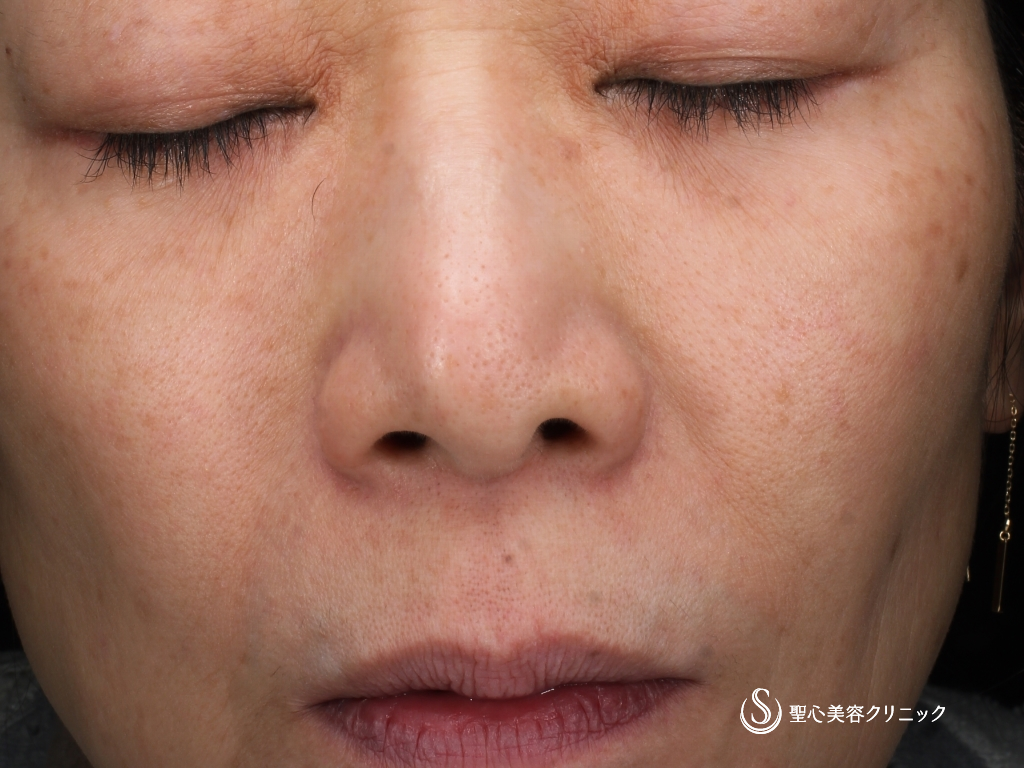 CellecV（セレックV）_After