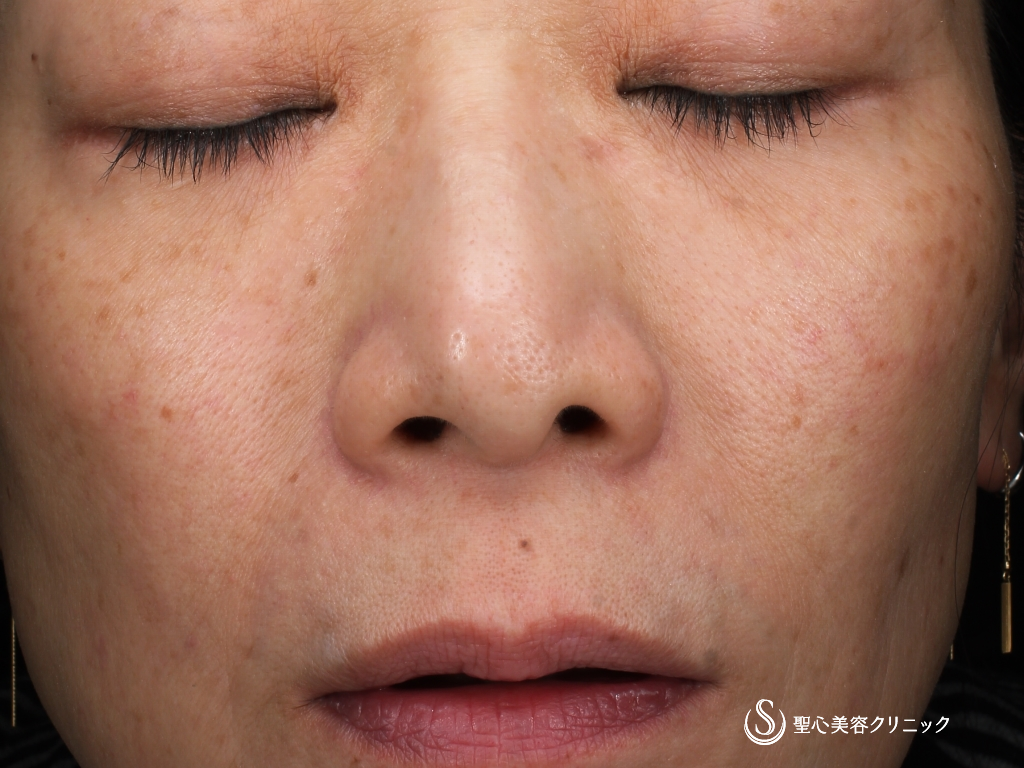 CellecV（セレックV）_Before