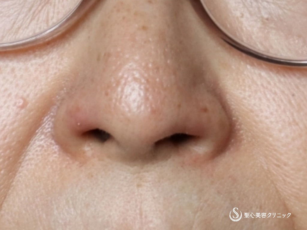 鼻孔縁下降術_After