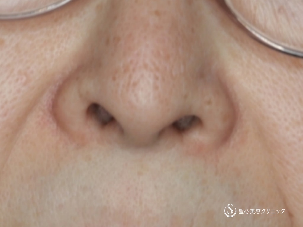 鼻孔縁下降術_Before