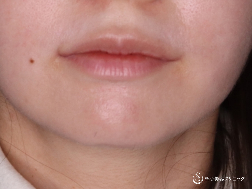 プレミアム口角挙上術_After