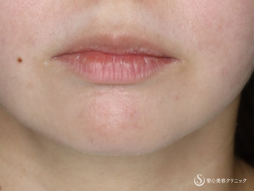 プレミアム口角挙上術_Before