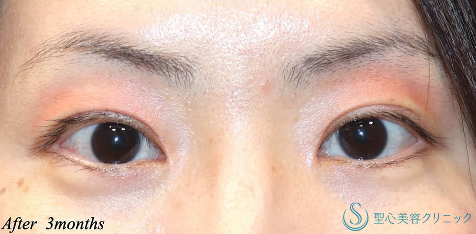 二重術（切開法）＋目頭切開/目上切開_Before