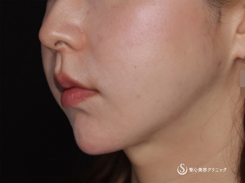 脂肪吸引注射（頬）＋アンカーMAX6本_After