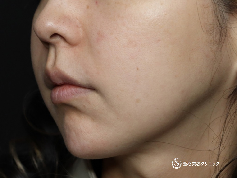 脂肪吸引注射（頬）＋アンカーMAX6本_Before