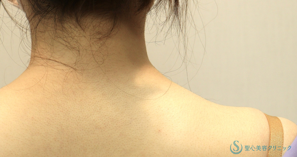 肩ボツリヌストキシン注入（注射）_Before