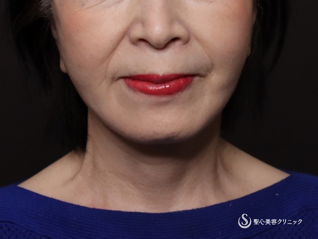 プレミアムミニリフト＋ネックリフト＋脂肪吸引注射（頬顎下）_After